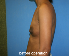 plastic-surgery-breast-augmentation